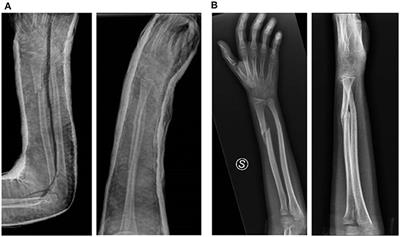 A Perspective on Management of Limb Fractures in Obese Children: Is It Time for Dedicated Guidelines?